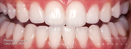 Teeth whitening after