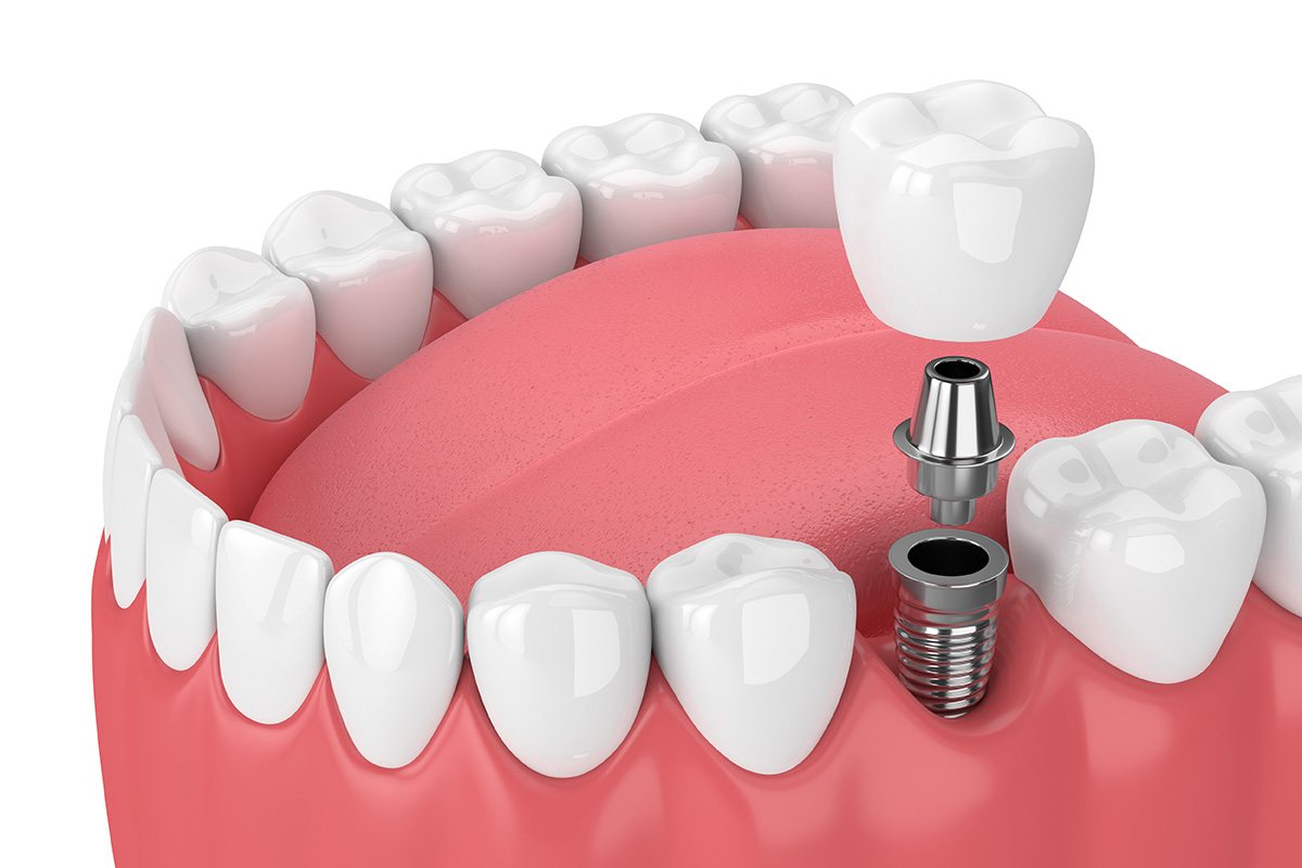 Dental implant technology and tools used by Dr. Moore to deliver precise implant dentistry.