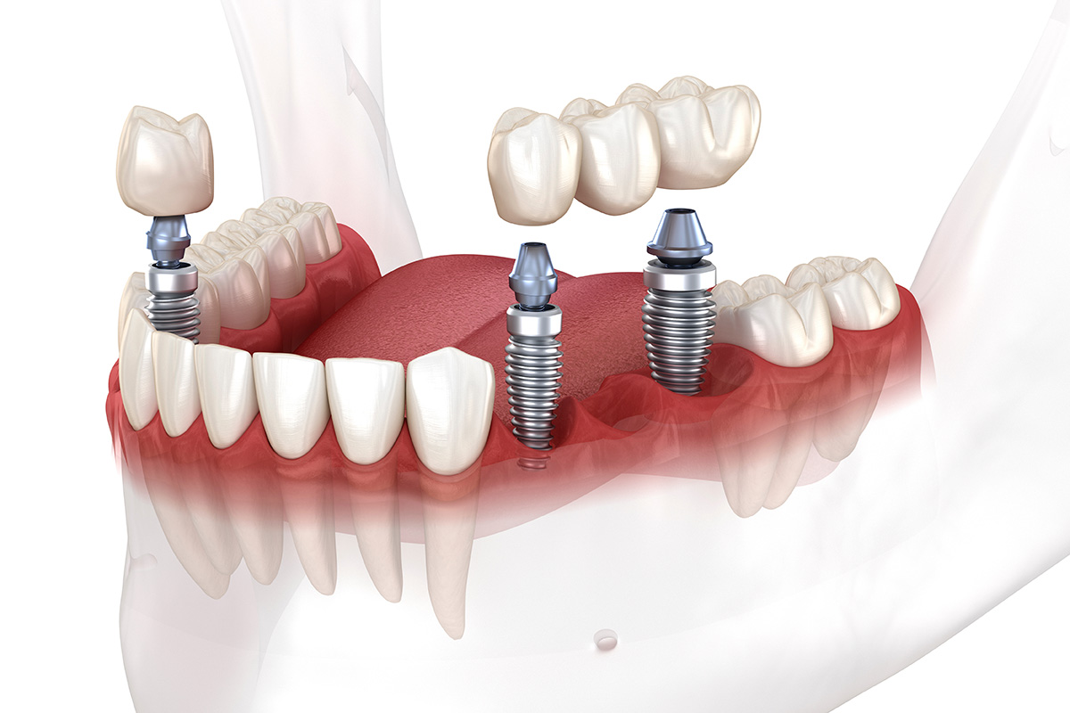 Diagram showing titanium dental implant anchored in jaw as replacement root in dentistry.