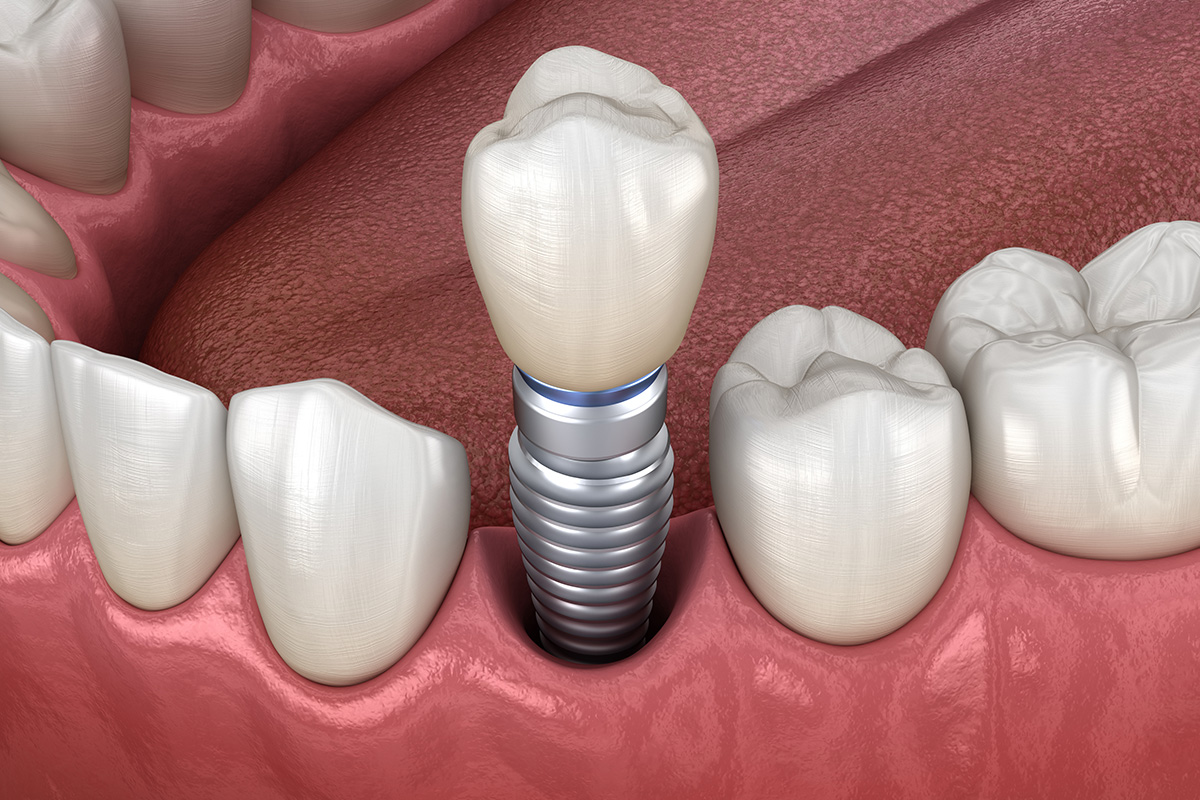 Dental implants