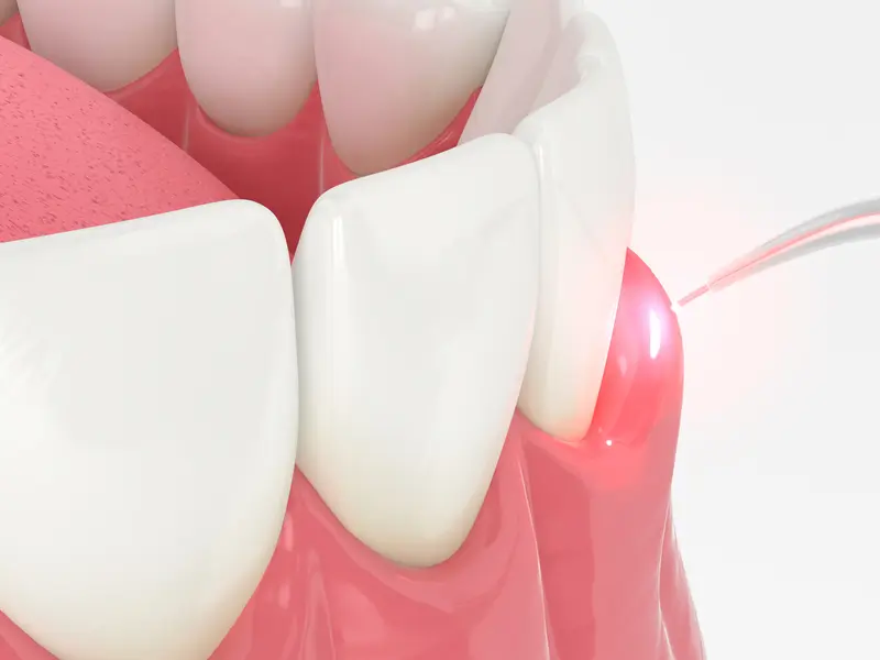 Gum disease treatment to restore healthy gums as part of general dentistry services.