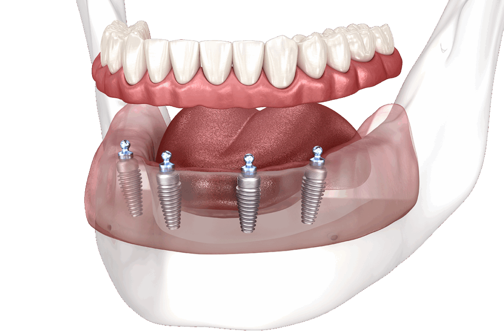 Full-arch dental implants delivering ‘New Teeth in One Day’ permanent smile in modern dentistry.