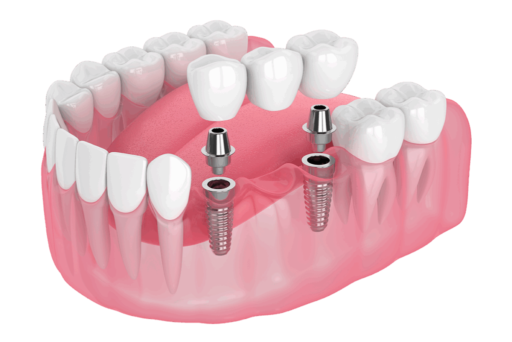 Dental implant supported  bridge replacing adjacent teeth, showcasing advanced dentistry care.