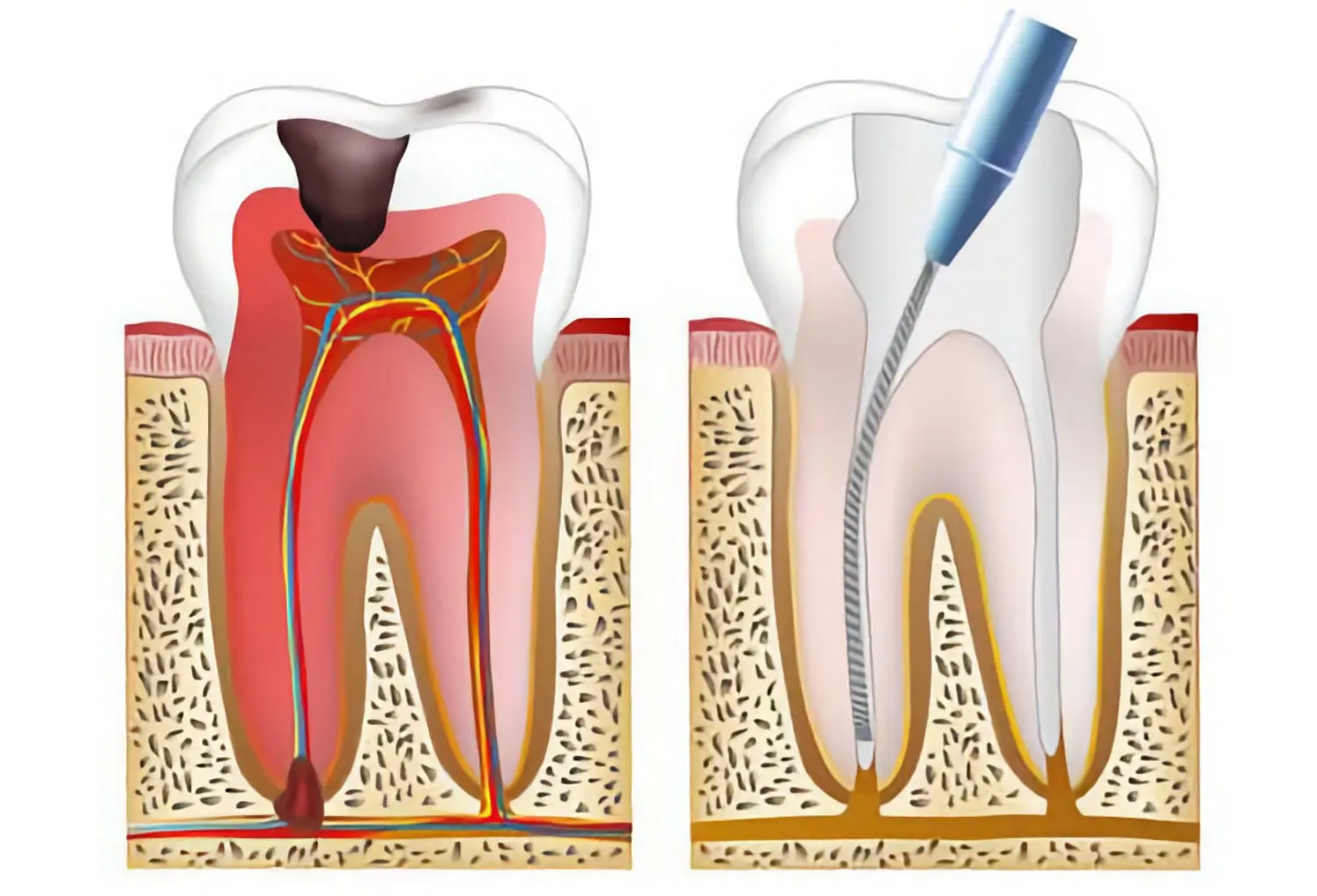 Root canal