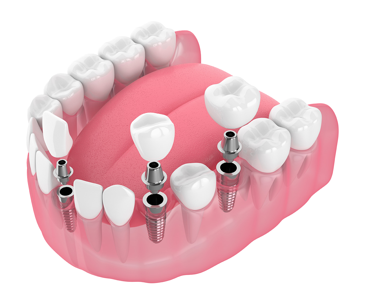 Single tooth replacement with dental implant and crown demonstrating modern dentistry solution.