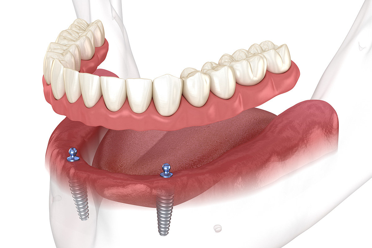 Diagram for Snap-In dentures option instead of All-on-X.