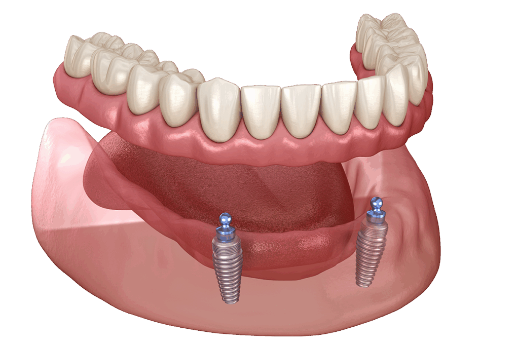 Snap-on denture stabilized by two to four dental implants for enhanced comfort and function in dentistry
