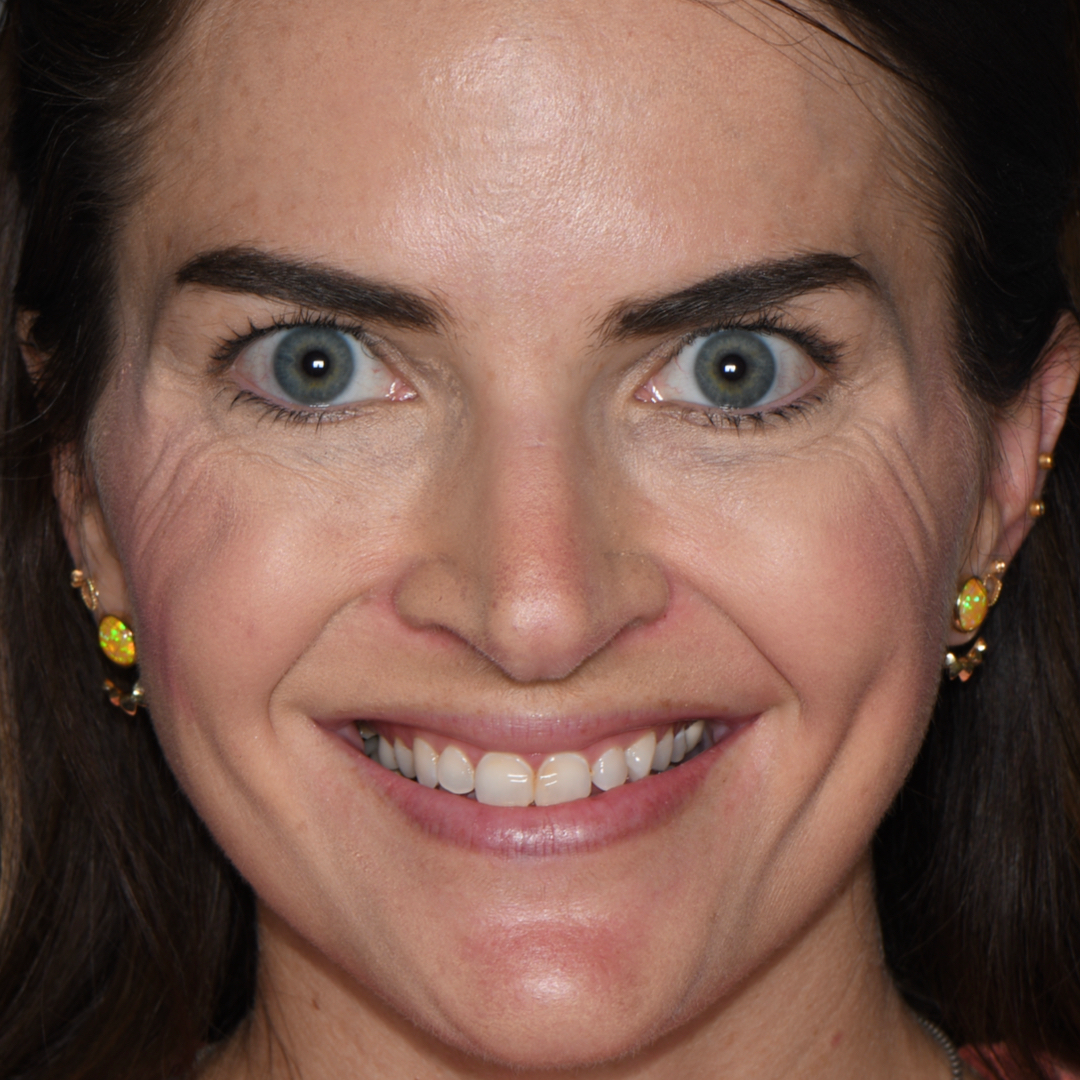 Before receving dental care at Moore Dental Arts.