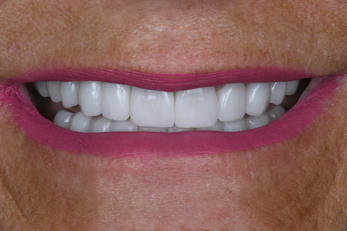 Smiling patient showing beautiful new dental implant smile after advanced dentistry treatment.
