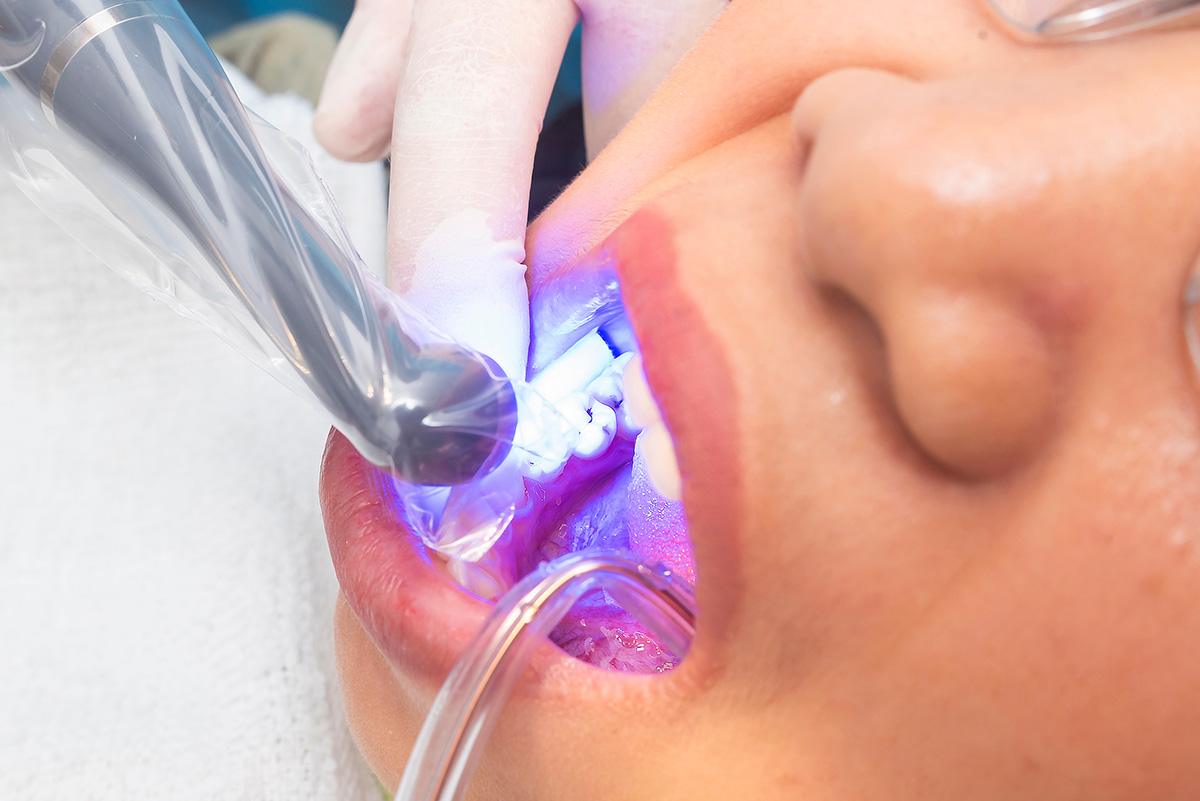 A patient under a dental bonding procedure