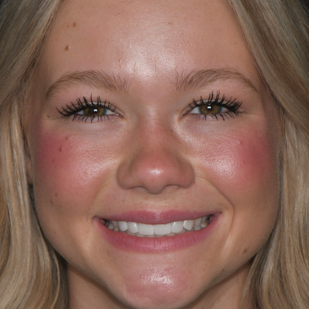 Younger patient after results from Moore Dental Arts.