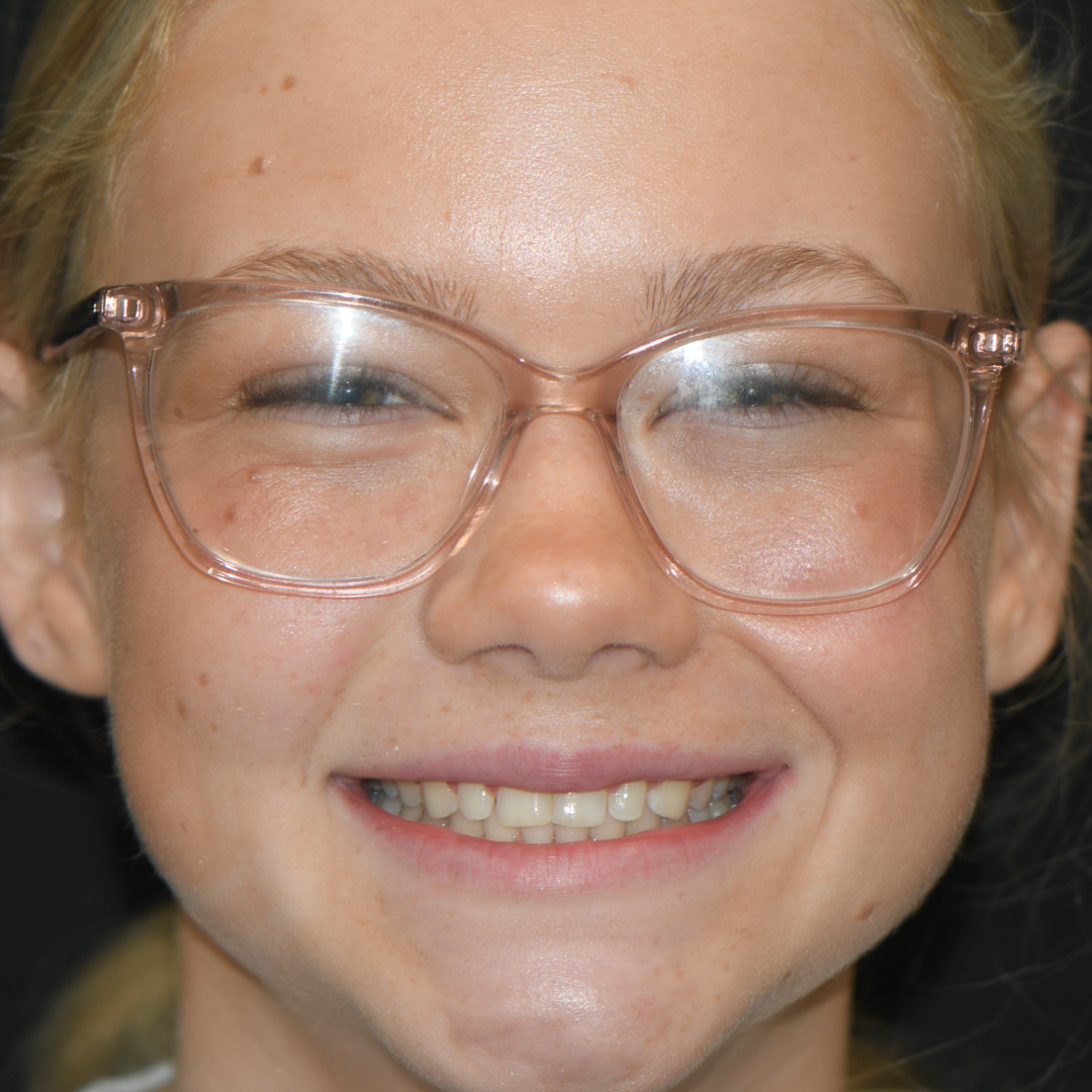 Younger patient before receiving care at Moore Dental Arts.
