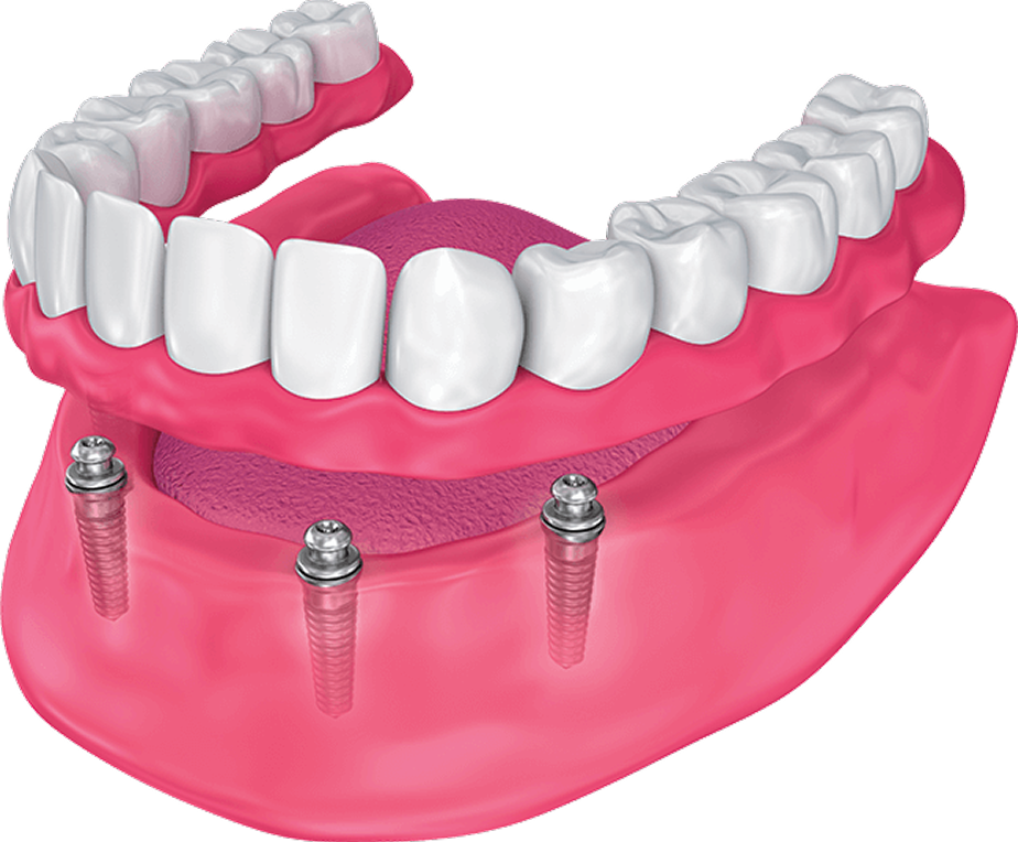 Snap on dentures diagram.